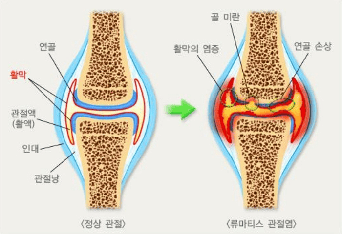 류마티스 관절염