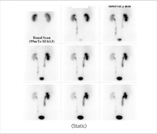신장 핵의학검사