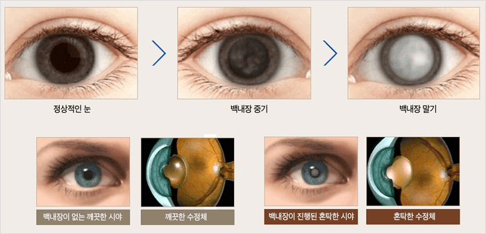 백내장 진단