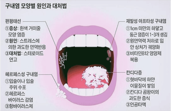 구내염 원인