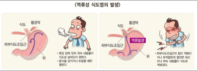 역류성 식도염 발생