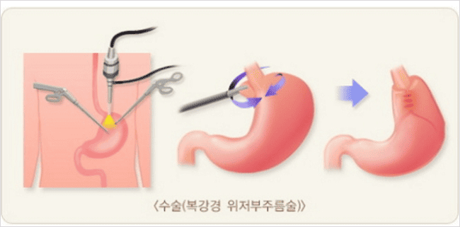 역류성 식도염 수술