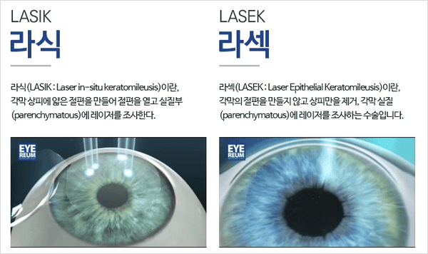 라식 라섹 차이
