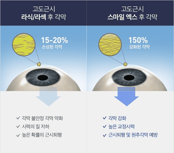 스마일라식 라식 라섹 차이