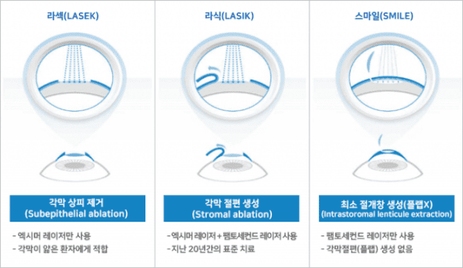 라식 라섹 비용