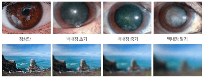백내장 초기 증상