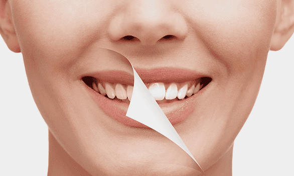 치아미백
