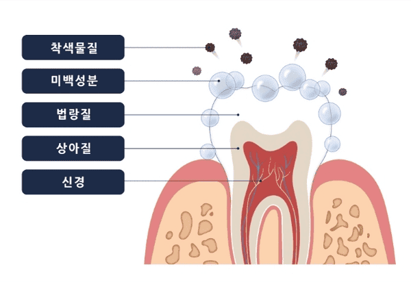 치아미백 가격 비용