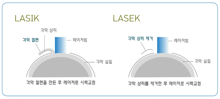라식 라섹 차이