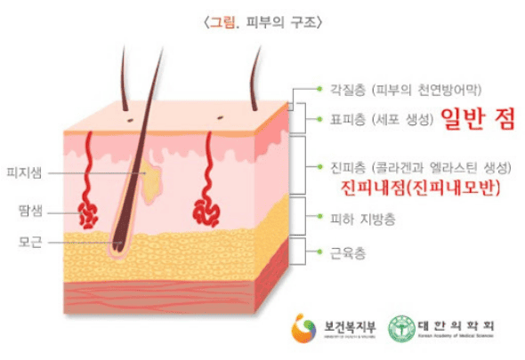 얼굴 점 빼기 방법
