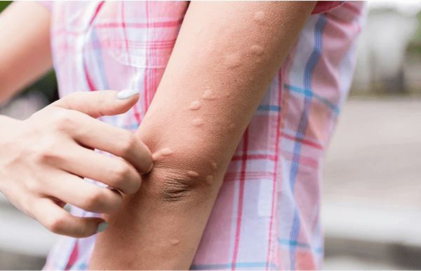 모기 물렸을 때 대처 방법