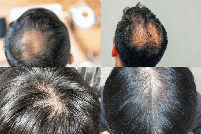 정수리 탈모 사진