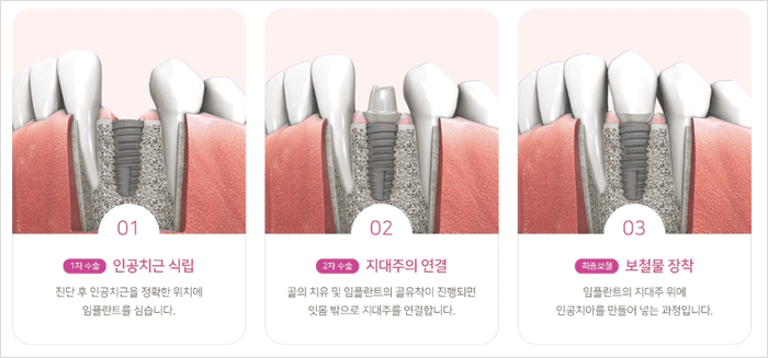 임플란트 과정