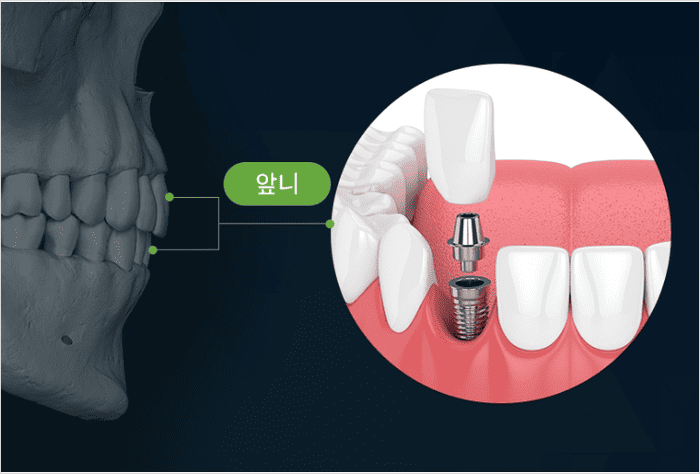 앞니 임플란트 가격