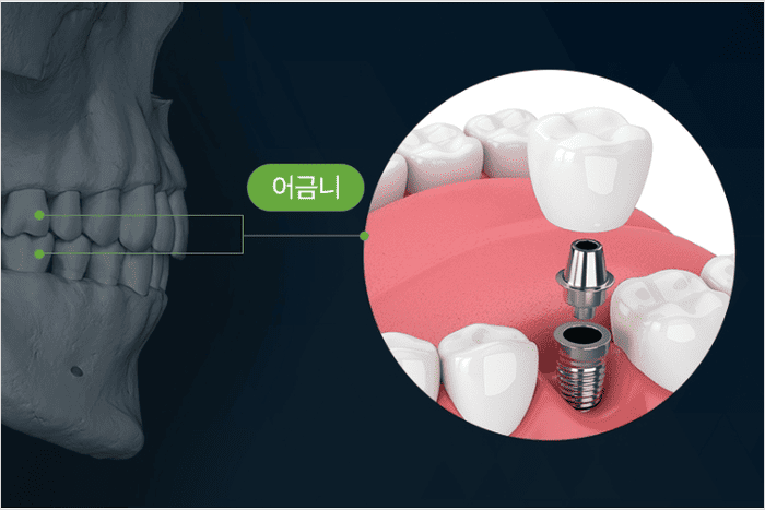 어금니 임플란트 가격