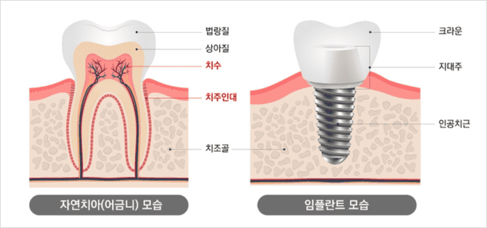 임플란트 보험