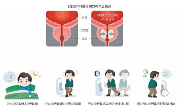 잔뇨량 개선