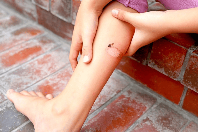 파상풍 예방접종