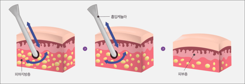지방흡입술 원리, 내장지방과의 관계
