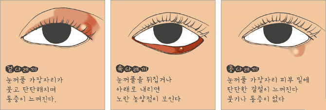 눈다래끼 증상