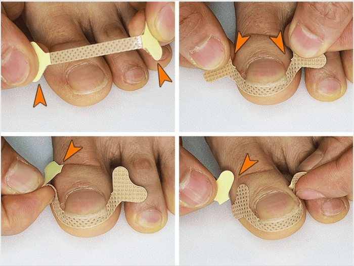 내성발톱 테이프