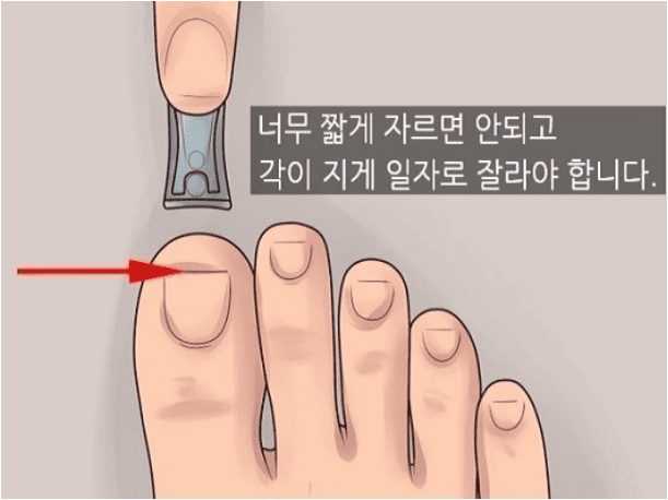 내성발톱 깍기