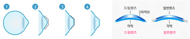 마이오가드와 드림렌즈 차이점