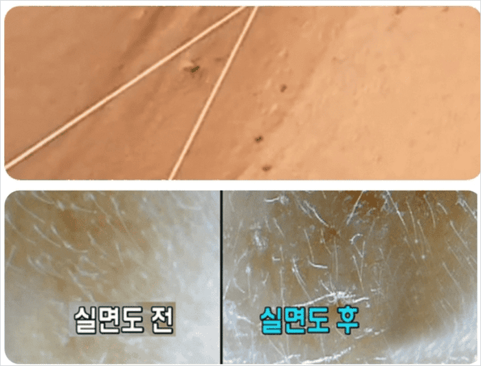 쥐젖 제거 실면도