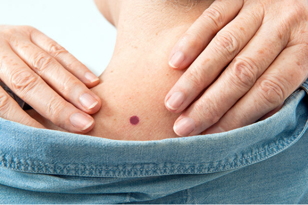 체리 혈관종 원인과 치료방법 피부 건강 관리 팁 체리 혈관종 원인과 치료방법 피부 건강 관리 팁